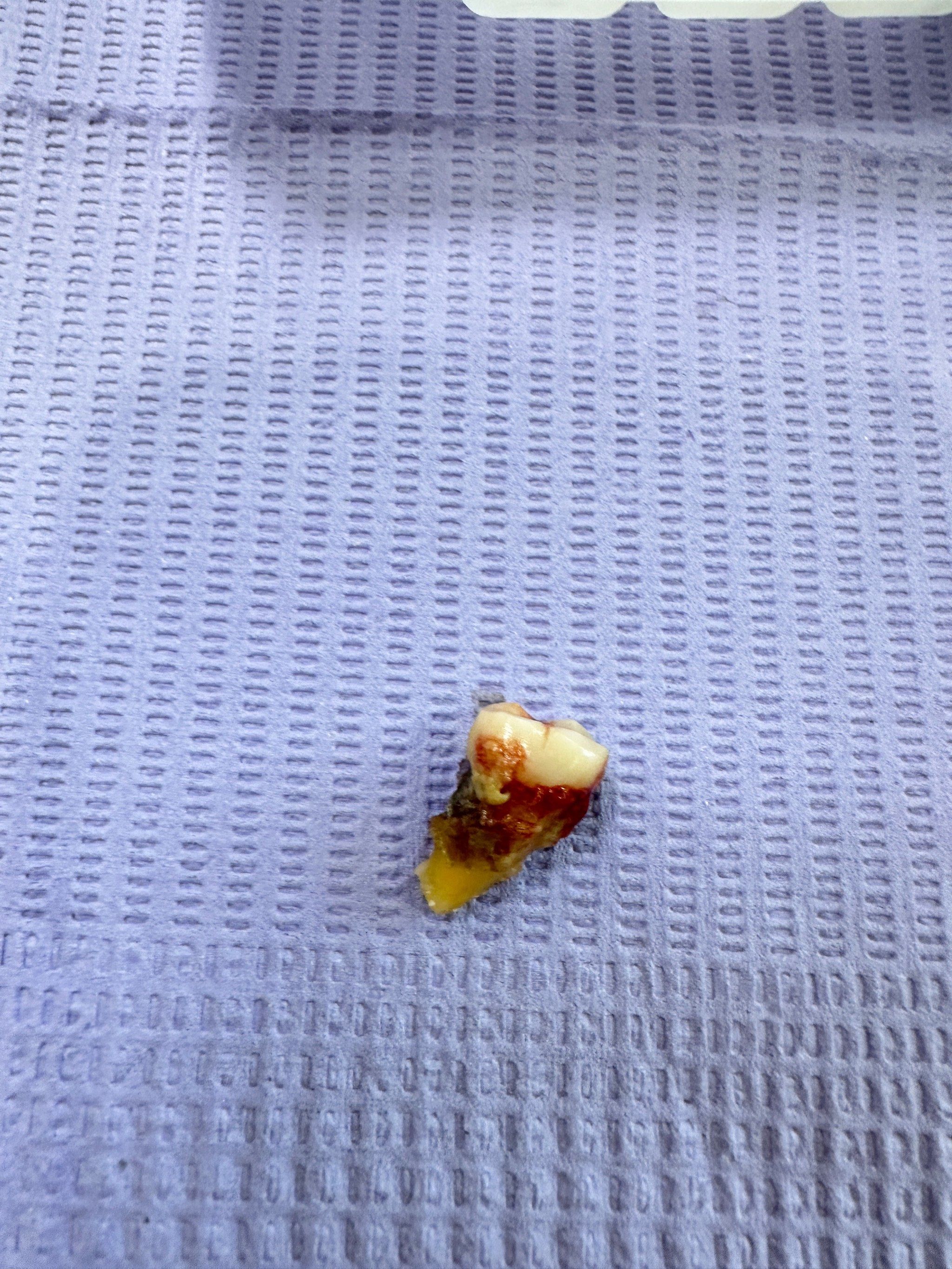 终于拔掉了这颗烂牙 准备后期种牙吧
