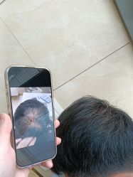 -碧莲盛·不剃发植发