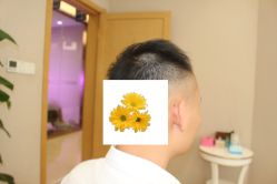 -大麦微针植发丨全国连锁