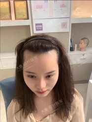 点击看大图 -大麦微针植发丨全国连锁