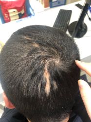 -大麦微针植发全国连锁