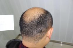 -大麦微针植发丨全国连锁