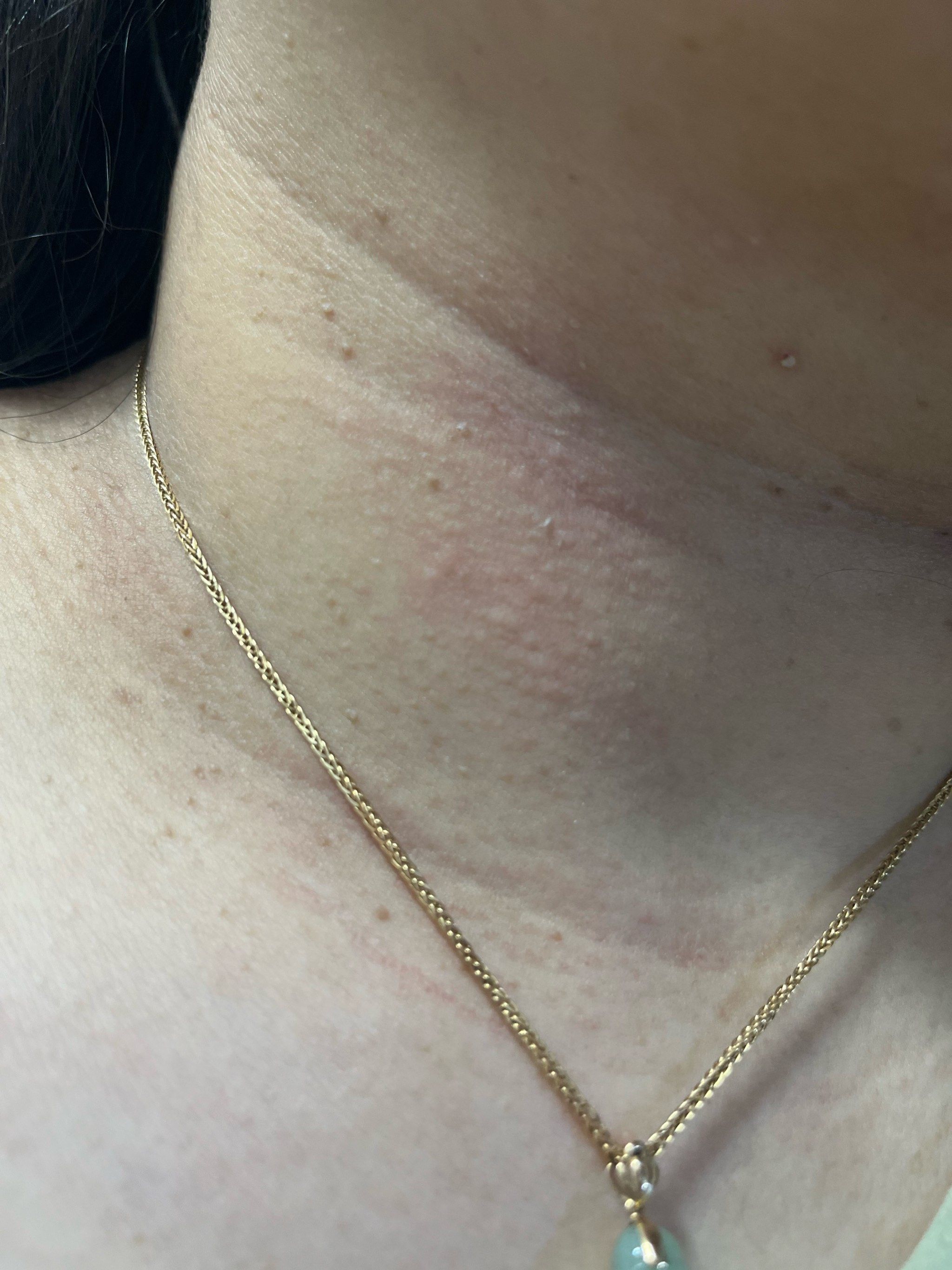 天天领红包太胖了 脖子上长了几个丝状疣