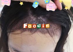 -大麦微针植发全国连锁