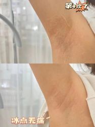-小梨·OndaPro·专业脱毛连锁机构