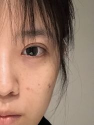 体验后-西安壹加壹医疗美容·西北抗衰旗舰店