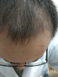 点击看大图 -大麦微针植发丨全国连锁