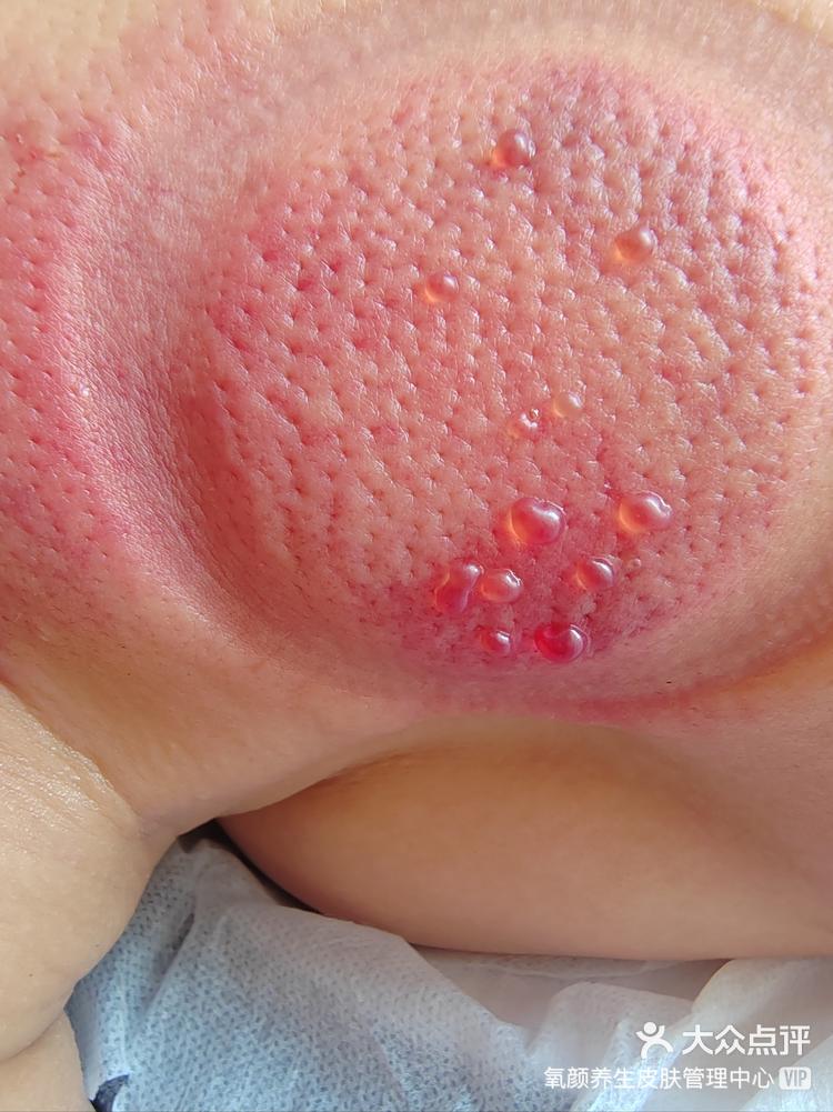 拔罐出水泡的情况(小知识开始啦)-大众点评