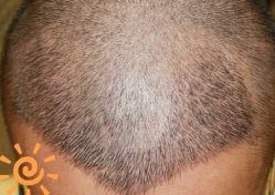 -大麦微针植发丨全国连锁