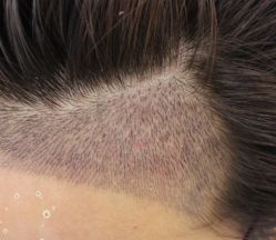 -大麦微针植发丨全国连锁