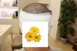 -大麦微针植发丨全国连锁