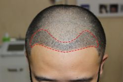 -大麦微针植发丨全国连锁