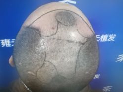 -雍禾植发全国连锁