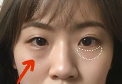 -天津健丽·去眼袋医疗美容机构