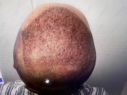 -雍禾植发全国连锁