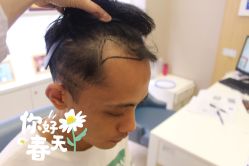 -大麦微针植发全国连锁