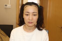 -大麦微针植发丨全国连锁