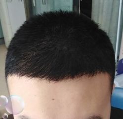 -大麦微针植发丨全国连锁