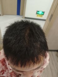 -大麦微针植发全国连锁