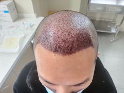 -大麦微针植发丨全国连锁