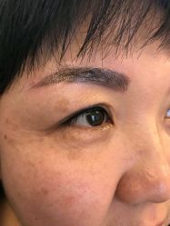 刚做完-北京英煌医疗美容