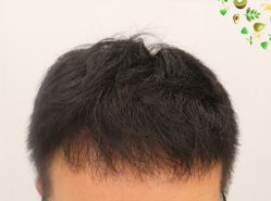 -大麦微针植发全国连锁