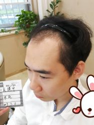 点击看大图 -大麦微针植发丨全国连锁