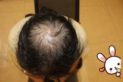 -大麦微针植发丨全国连锁