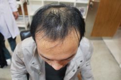 -大麦微针植发丨全国连锁