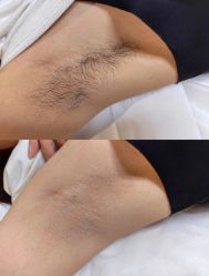 -薇兰专业脱毛连锁机构