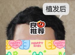 -大麦微针植发全国连锁