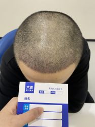 -大麦微针植发全国连锁