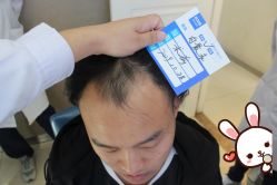 -大麦微针植发丨全国连锁