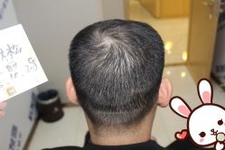 -大麦微针植发丨全国连锁