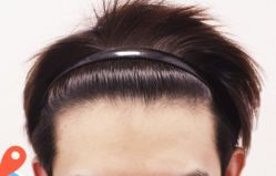 -大麦微针植发丨全国连锁