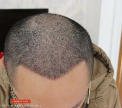 -大麦微针植发丨全国连锁