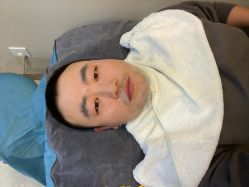 体验后-More摩尔医美の注射线雕光电中心