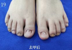 -德哥灰指甲脚气甲沟炎跖疣护理