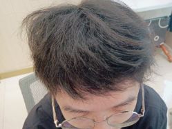 点击看大图 -碧莲盛·不剃发植发