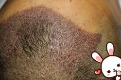 点击看大图 -大麦微针植发丨全国连锁