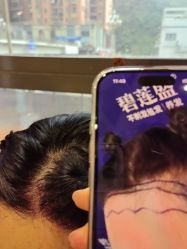 -碧莲盛·不剃发植发