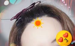 -大麦微针植发全国连锁