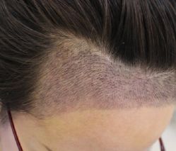 -大麦微针植发全国连锁