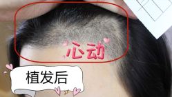 -大麦微针植发全国连锁