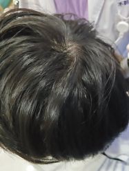 -碧莲盛不剃发植发