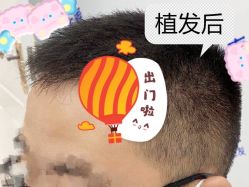 -大麦微针植发全国连锁