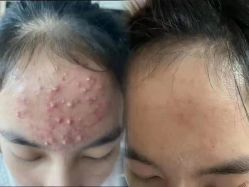 -瑶芳清颜草本祛痘