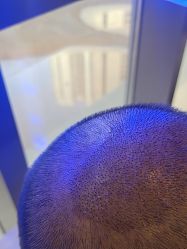 -碧莲盛·不剃发植发