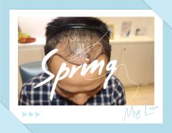 点击看大图 -大麦微针植发全国连锁