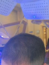 -碧莲盛·不剃发植发